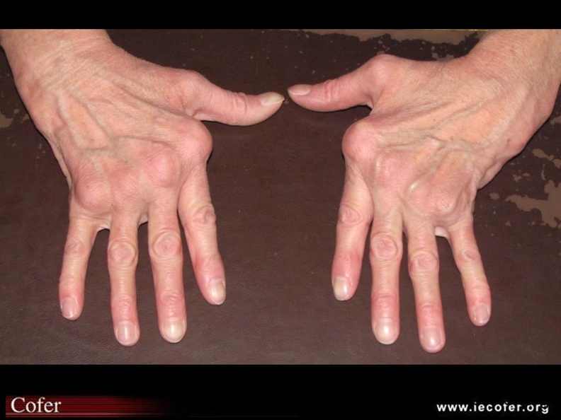 mains de Jaccoud au cours d'un lupus éruthémateux systémique